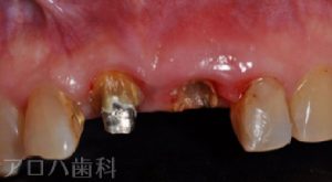 前歯部欠損症例