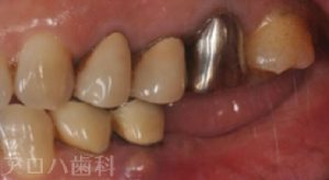 臼歯部欠損症例